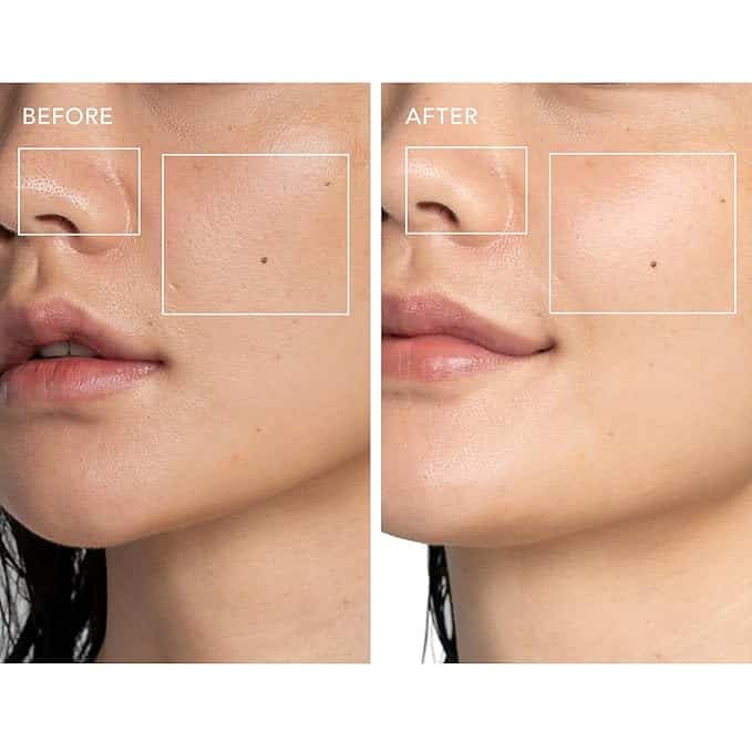 Acne Treatment ESPADA™ 2 plus
